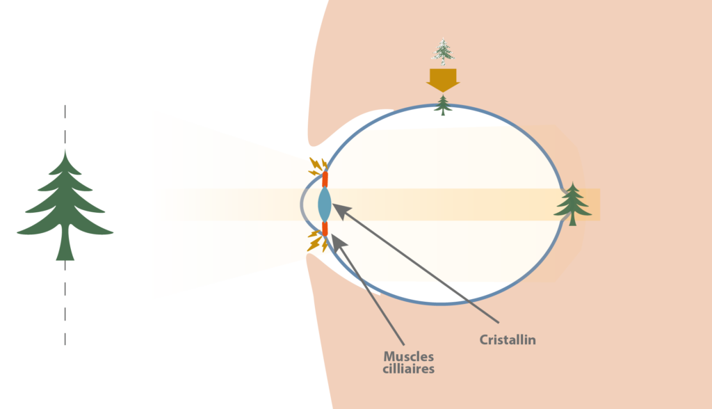 oeil myopie evolutive