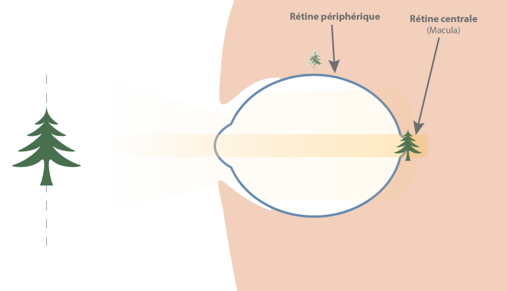 potentiel vision oeil myopise